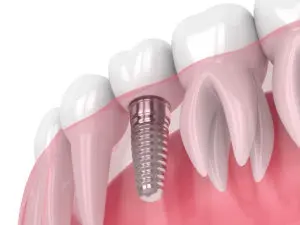 dental implants Mansfield TX