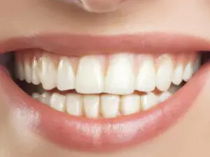 https://www.pexels.com/photo/beautiful-gummy-smile-with-white-teeth-16212691/ smile after teeth whitening in Dallas, TX
