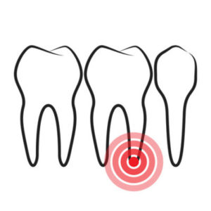 root canal Mansfield