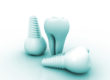 dental implants | Crosspointe Dental | Mansfield TX