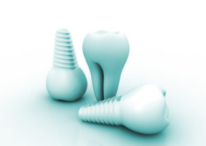 dental implants Mansfield TX