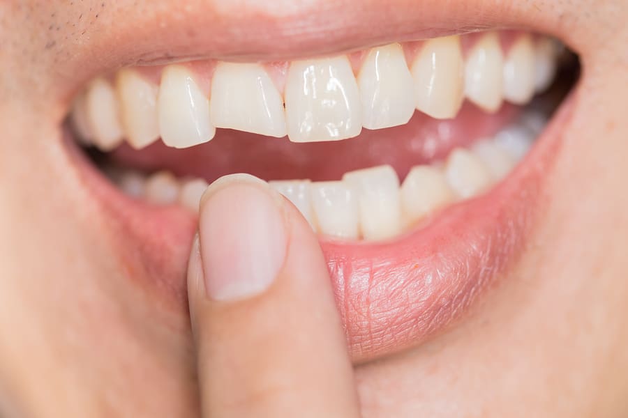 Caring For A Chipped Teeth Ashley Coerver DDS