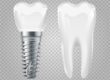 dental implants Mansfield TX