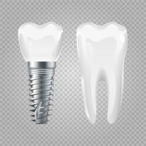 dental implants Mansfield TX